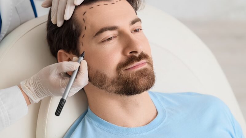 Does Hair Transplant Hurt? Pain, Process & Myths Guide by mornigsun